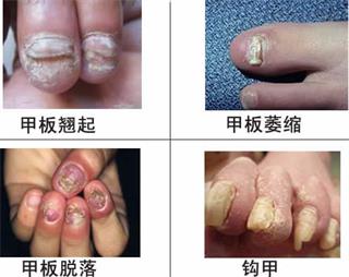 广州肤康皮肤病医院