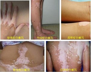广州肤康皮肤病医院